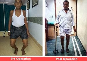 Best Knee Joint Replacement Surgeon in Delhi NCR India | Dr. Shekhar