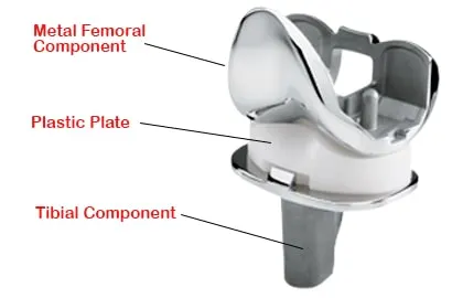 Knee-Implant-1