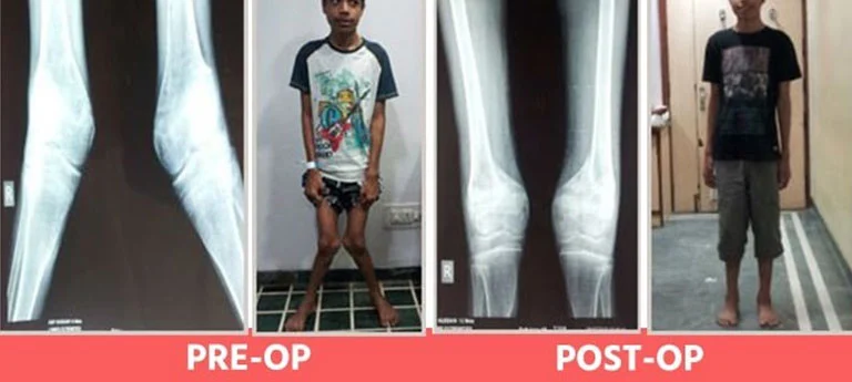Knee-Surgery-for-Deformity-Correction