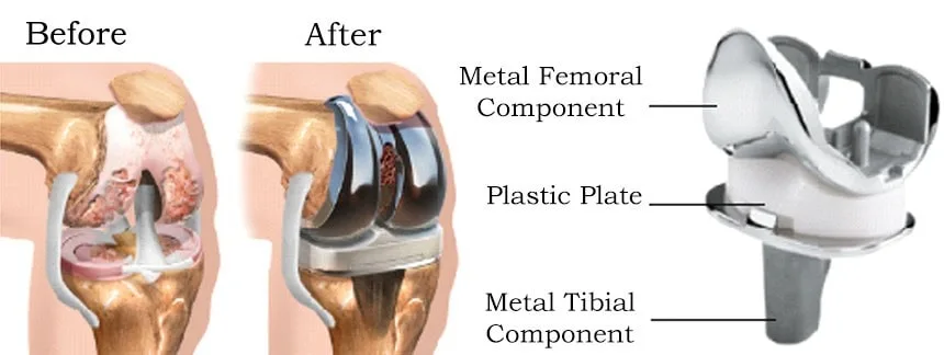 Knee-joint-Replacement.jpg