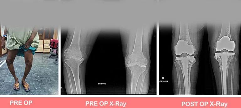 Primary-complex-Total-Knee-Replacement
