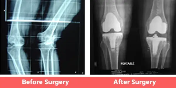 Wind-Swept-Legs-Knees